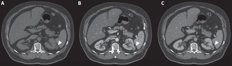 Diagnostic Imaging for Solid Renal Tumors: A Pictorial Review.