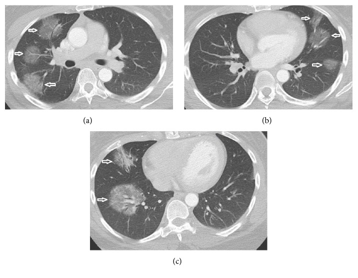 Mass-Like Ground-Glass Opacities in Sarcoidosis: A Rare Presentation Not Previously Described.