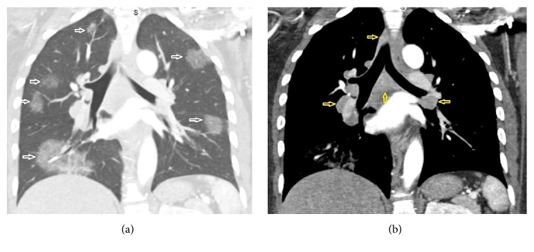 Mass-Like Ground-Glass Opacities in Sarcoidosis: A Rare Presentation Not Previously Described.