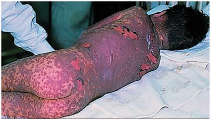 Tolerance Induction to Antituberculosis Drugs in a Patient With Stevens-Johnson Syndrome/Toxic Epidermal Necrolysis Overlap.