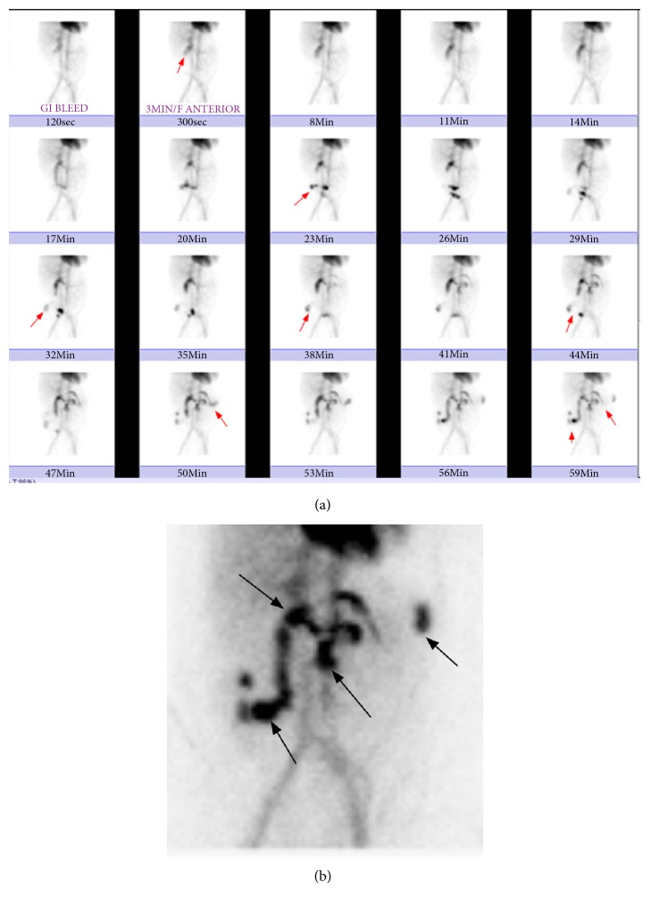 Successful Localization of the Source of Hemorrhage in Patient with Post-Whipple Surgery by <sup>99m</sup>Tc-Labelled Red Blood Cell Scintigraphy.