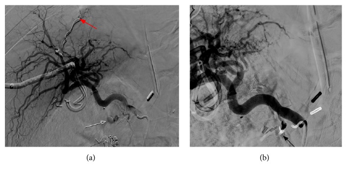 Successful Localization of the Source of Hemorrhage in Patient with Post-Whipple Surgery by <sup>99m</sup>Tc-Labelled Red Blood Cell Scintigraphy.