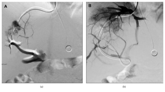 Direct Intrahepatic Portosystemic Shunt in Budd-Chiari Syndrome: A Case Report and Review of the Literature.