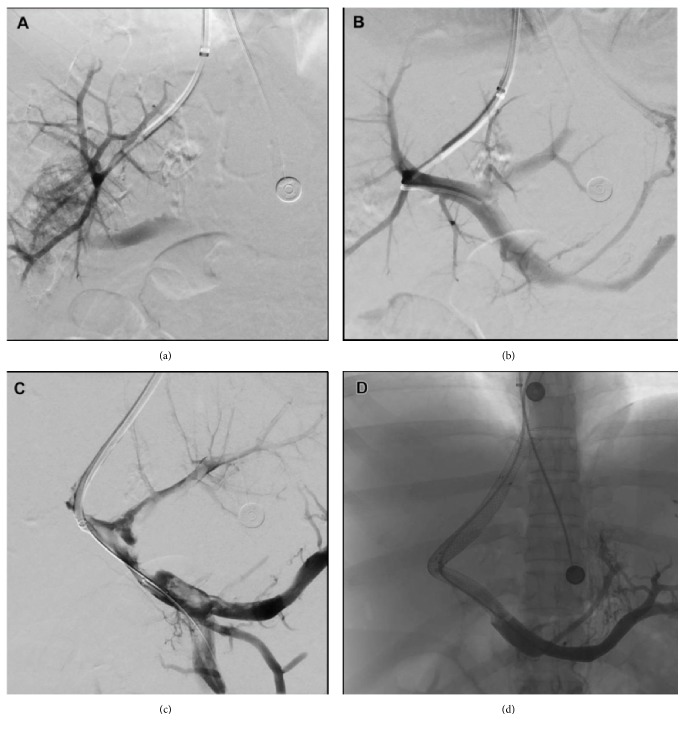 Direct Intrahepatic Portosystemic Shunt in Budd-Chiari Syndrome: A Case Report and Review of the Literature.