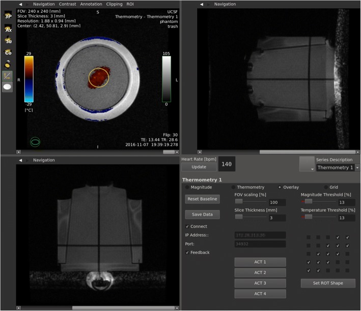 MR thermometry-guided ultrasound hyperthermia of user-defined regions using the ExAblate prostate ablation array.