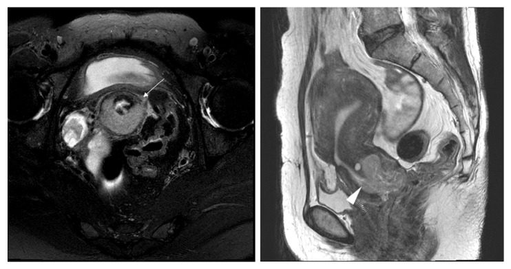 Early Cervical Cancer: Predictive Relevance of Preoperative 3-Tesla Multiparametric Magnetic Resonance Imaging.