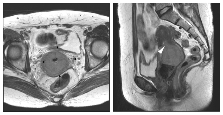 Early Cervical Cancer: Predictive Relevance of Preoperative 3-Tesla Multiparametric Magnetic Resonance Imaging.