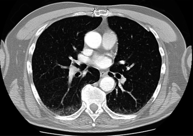 Guillain Barré syndrome associated with bladder instillation of Bacille Calmette Guérin (BCG).