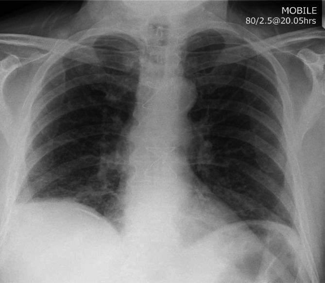 Guillain Barré syndrome associated with bladder instillation of Bacille Calmette Guérin (BCG).