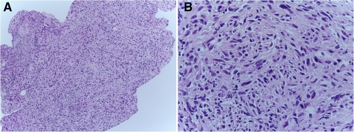 Diagnostic pitfall: primary myoepithelial carcinoma of the lacrimal gland, case report and literature review.