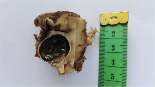 Diagnostic pitfall: primary myoepithelial carcinoma of the lacrimal gland, case report and literature review.