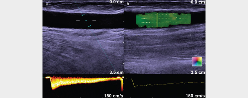 Evaluation of Peak Reflux Velocities with Vector Flow Imaging and Spectral Doppler Ultrasound in Varicose Veins.