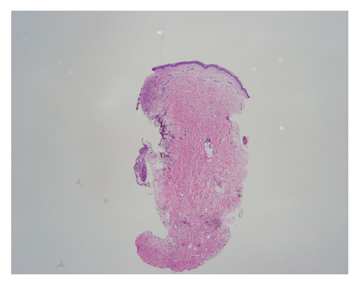 Acute Liver Failure due to Disseminated Varicella Zoster Infection.