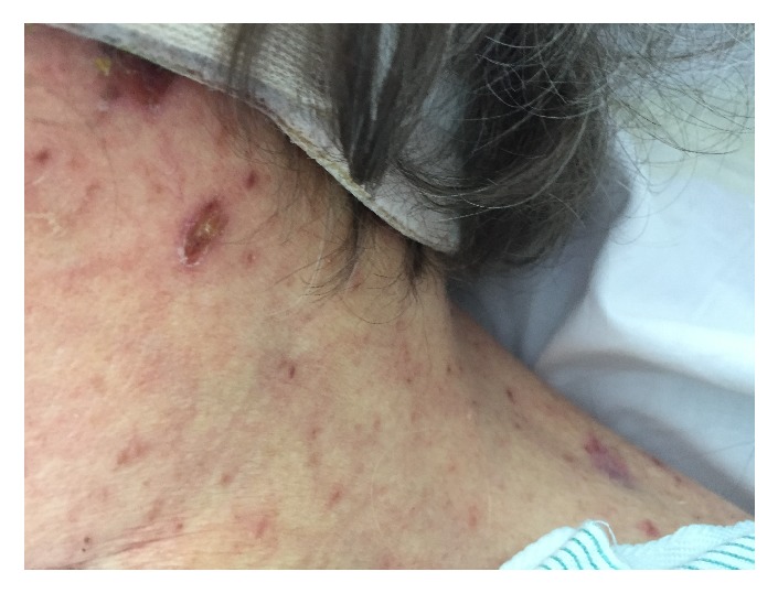Acute Liver Failure due to Disseminated Varicella Zoster Infection.