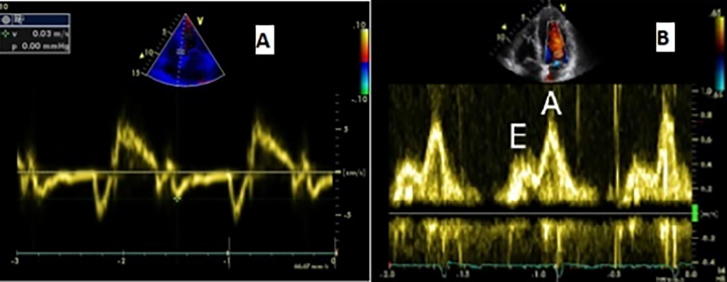 Role of speckle tracking echocardiography in detecting early left atrial dysfunction in hypertensive patients