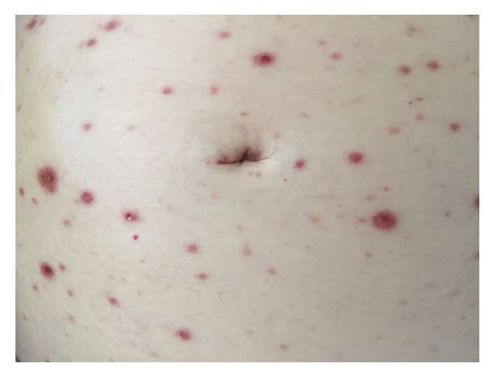 Acute Liver Failure due to Disseminated Varicella Zoster Infection.