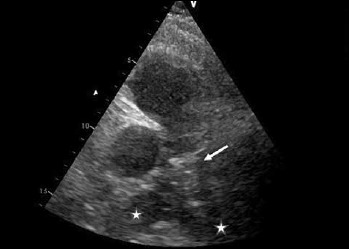 Myotonic dystrophy type 1 and pulmonary embolism: successful thrombus resolution with dabigatran etexilate therapy.