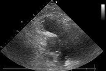 Myotonic dystrophy type 1 and pulmonary embolism: successful thrombus resolution with dabigatran etexilate therapy.