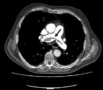 Myotonic dystrophy type 1 and pulmonary embolism: successful thrombus resolution with dabigatran etexilate therapy.