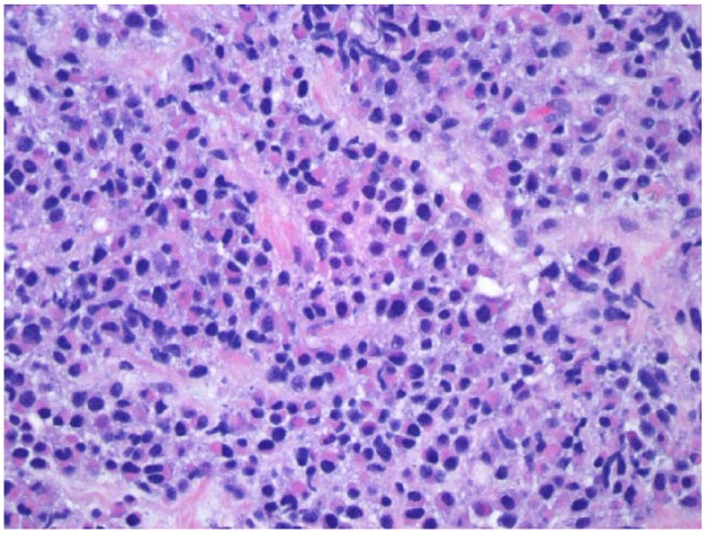 Pancreatic Extramedullary Plasmacytoma Presenting as a Pancreatic Mass.