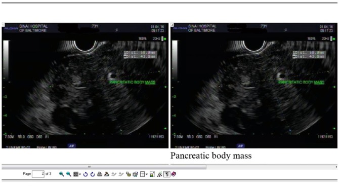 Pancreatic Extramedullary Plasmacytoma Presenting as a Pancreatic Mass.