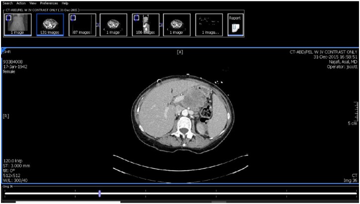 Pancreatic Extramedullary Plasmacytoma Presenting as a Pancreatic Mass.