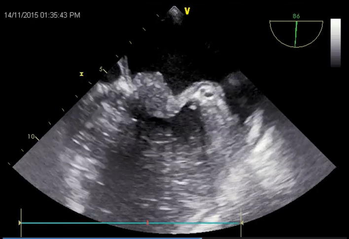 Primary cardiac hemangioendothelioma of the mitral valve