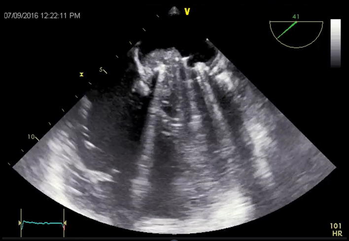 Primary cardiac hemangioendothelioma of the mitral valve