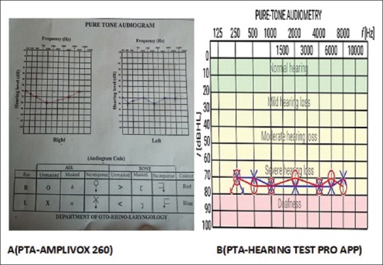 Evaluation of the Hearing Test Pro Application as a Screening Tool for Hearing Loss Assessment.