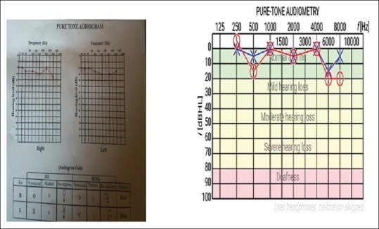 Evaluation of the Hearing Test Pro Application as a Screening Tool for Hearing Loss Assessment.