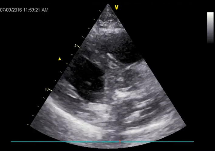 Primary cardiac hemangioendothelioma of the mitral valve