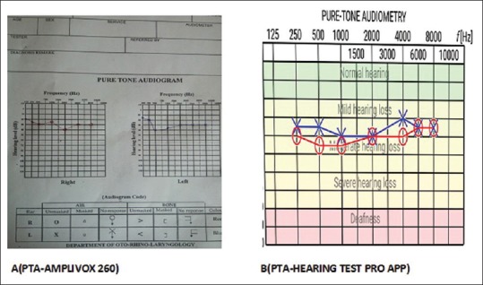 Evaluation of the Hearing Test Pro Application as a Screening Tool for Hearing Loss Assessment.