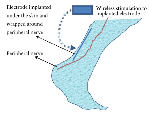 Current Innovations in Peripheral Nerve Stimulation.