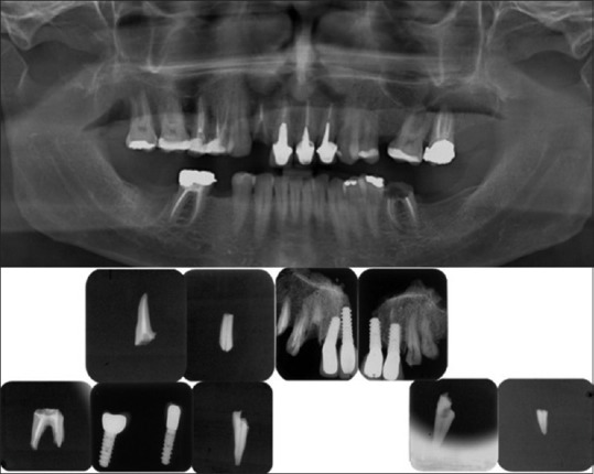Charred: Forensic dental identification and scanning electron microscope.
