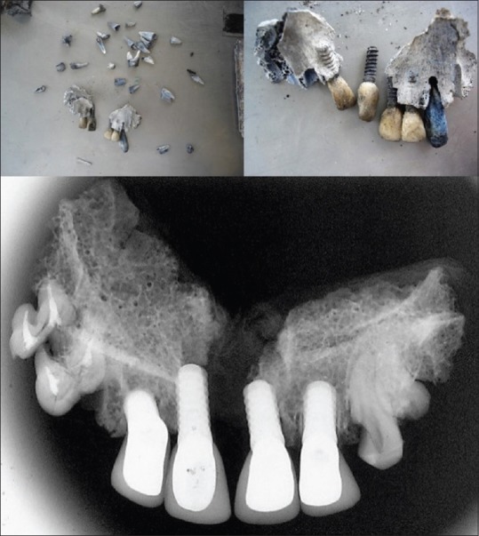 Charred: Forensic dental identification and scanning electron microscope.