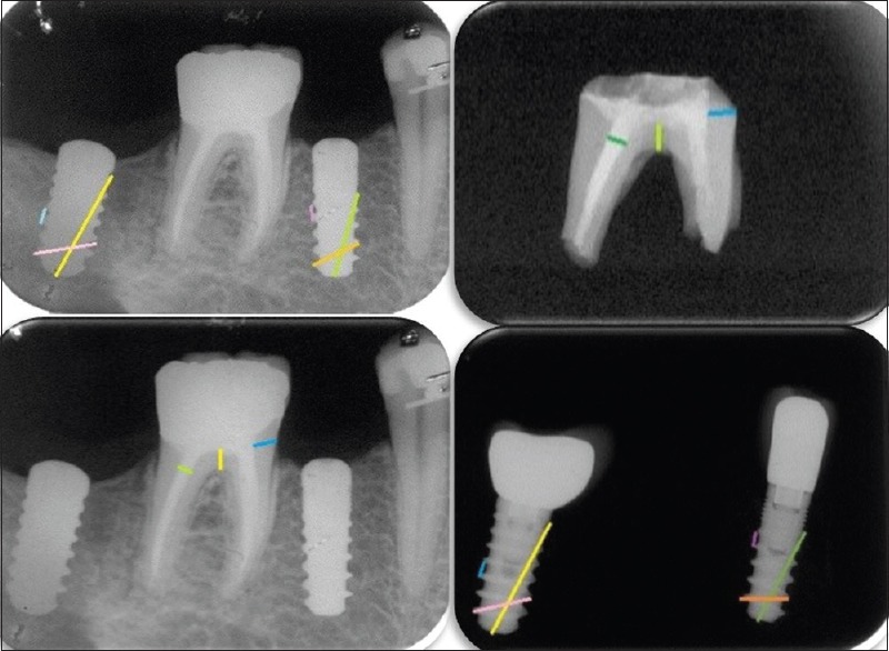 Charred: Forensic dental identification and scanning electron microscope.