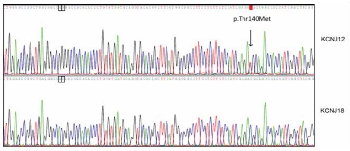 Kir2.2 p.Thr140Met: a genetic susceptibility to sporadic periodic paralysis.