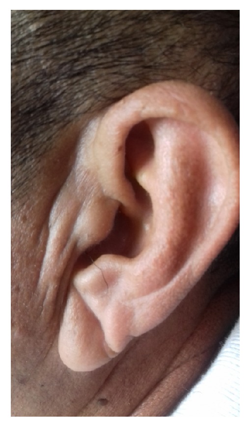 The Association between Earlobe Crease (Frank's Sign) and Abnormal Ankle-Brachial Index Determination Is Related to Age: A Population-Based Study.