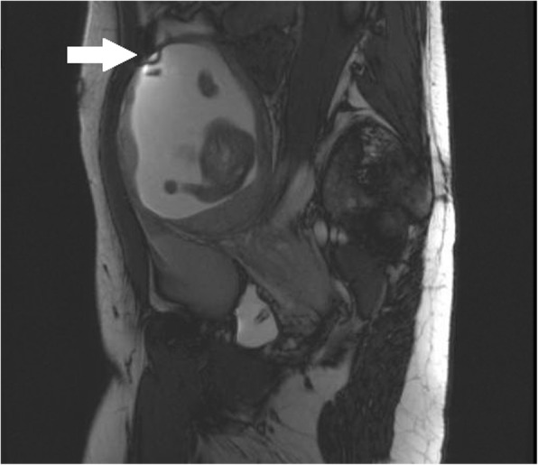 Diagnosis and management of a heterotopic pregnancy and ruptured rudimentary uterine horn.