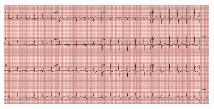 Head Down Deep Breathing for Cardioversion of Paroxysmal Supraventricular Tachycardia.