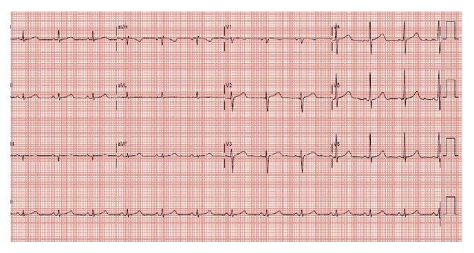 Head Down Deep Breathing for Cardioversion of Paroxysmal Supraventricular Tachycardia.