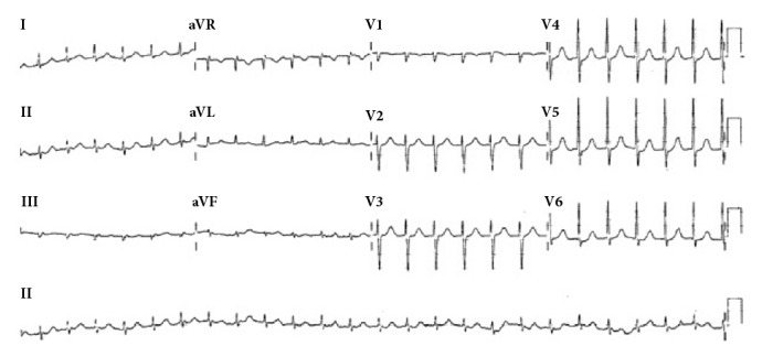 Head Down Deep Breathing for Cardioversion of Paroxysmal Supraventricular Tachycardia.