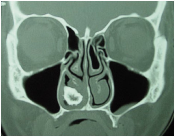 Rhinolithiasis: A Misleading Entity.