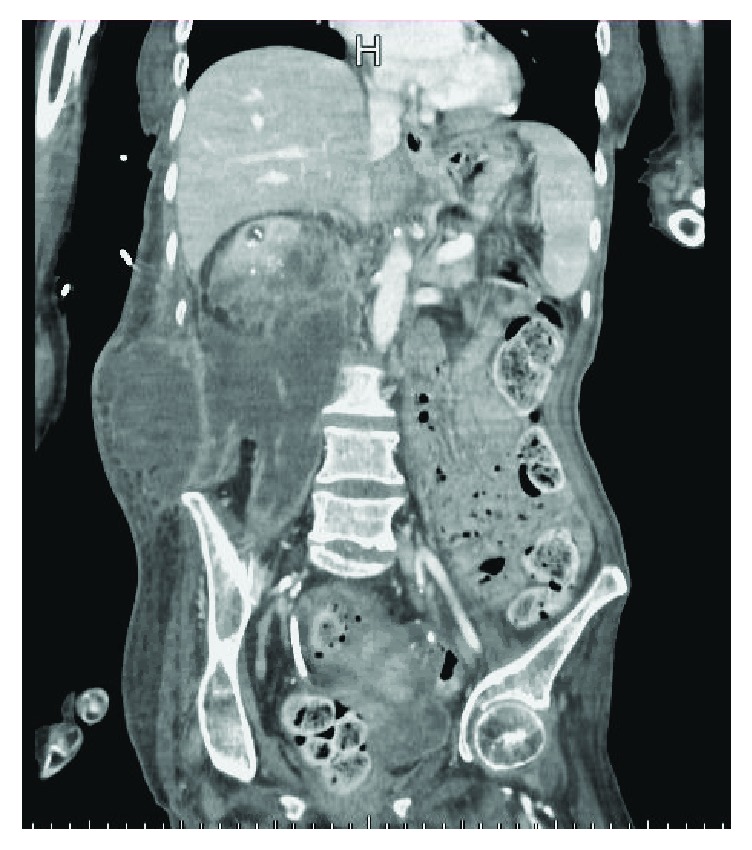 Urinoma: Prompt Diagnosis and Treatment Can Prevent Abscess Formation, Hydronephrosis, and a Progressive Loss of Renal Function.