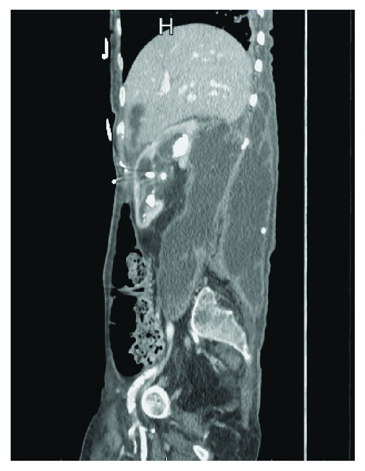 Urinoma: Prompt Diagnosis and Treatment Can Prevent Abscess Formation, Hydronephrosis, and a Progressive Loss of Renal Function.