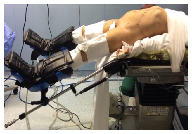 Robotic-Assisted versus Conventional Laparoscopic Approach for Rectal Cancer Surgery, First Egyptian Academic Center Experience, RCT.