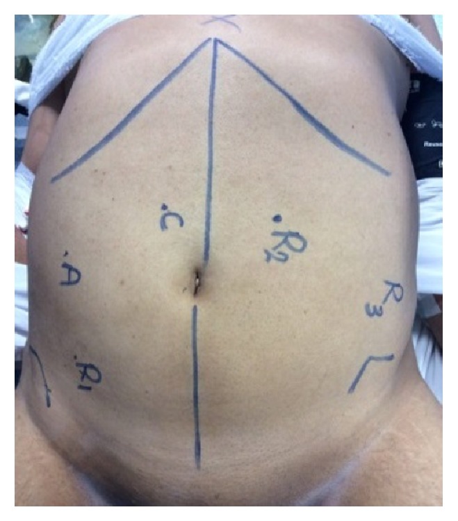 Robotic-Assisted versus Conventional Laparoscopic Approach for Rectal Cancer Surgery, First Egyptian Academic Center Experience, RCT.