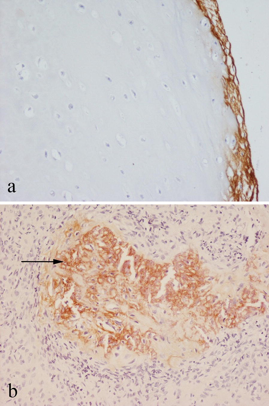 Periostin expression in neoplastic and non-neoplastic diseases of bone and joint.