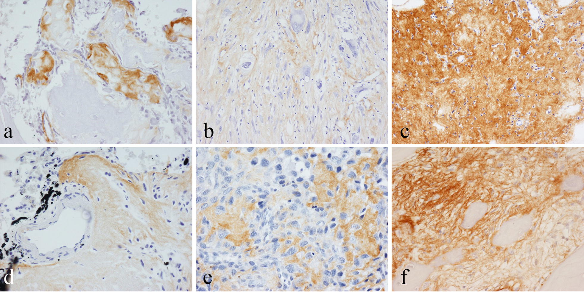 Periostin expression in neoplastic and non-neoplastic diseases of bone and joint.