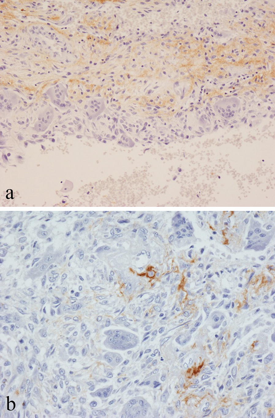 Periostin expression in neoplastic and non-neoplastic diseases of bone and joint.